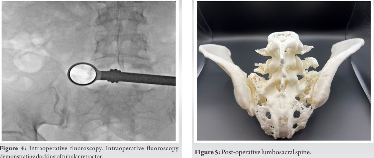Fresh off the press! The application of 3D printing in MIS surgery planning. Check out this Bertolotti MIS resection after 3D pelvis print (comparative before and after surgery) pubmed.ncbi.nlm.nih.gov/38292111/ @UTSWBrain @utswspine @dr_carlosbagley