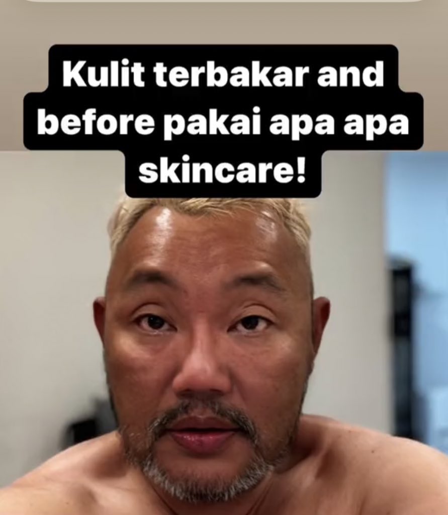 itssssssssara's tweet image. Patutla viral skincare apa Michael Ang ni pakaiii. Dalam masa 20 hari je, dari sunburn teruk, kulit terus helok flawless macam kulit babyy. Proven method👍💯

Scroll for more👇