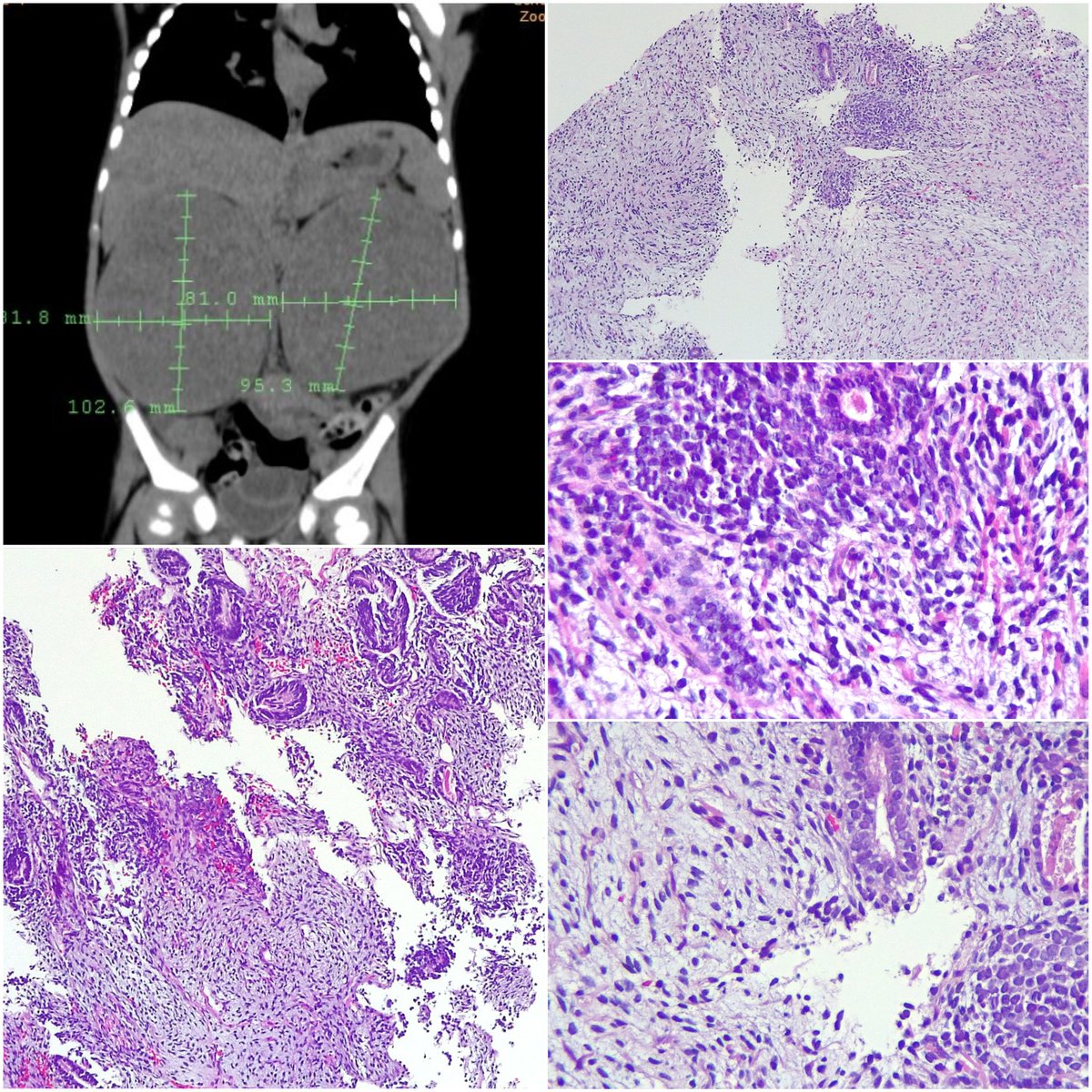 Nephroblastoma (or Wilms tumor) BILATERAL. #nephroblastoma #wilmstumor ☹️😞