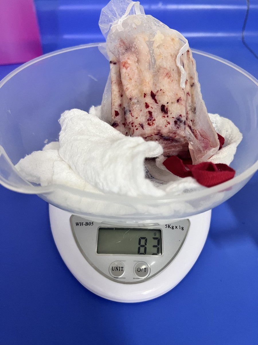 WestendarpM's tweet photo. Successful Bipolar Enucleation #bph #bipolep #endourology
@filialendouro @GoumasUrologia @Moser_DanielC @trwherrmann https://t.co/rxlg3vJFyv