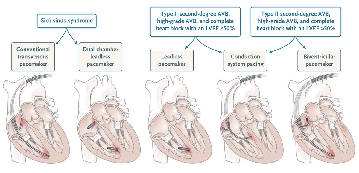 A new Review Article highlights recent developments in cardiac implantable electronic devices, with an emphasis on pacemakers, newer modes of pacing, and implantable cardioverter–defibrillators. Read the full article: nej.md/4bftSBj