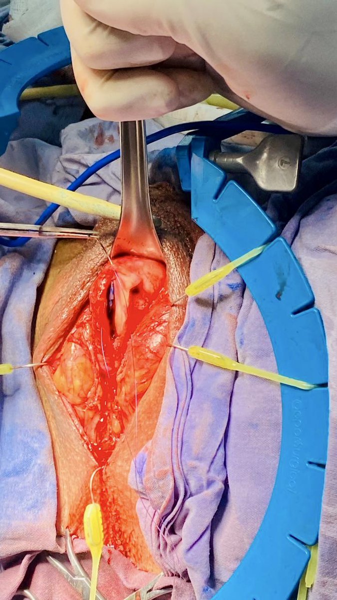 Hoy hicimos un caso interesante paciente con estenosis bulbopeneana + contractura cuello vesical y 3 UTI previas secundario a Rtup. Se realizó plastia con BMG + cervicotomia con asa de Collin’s accessndo por uretrostomia. <a href="/Aldolsterona/">Dr. Almeida</a>