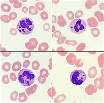 1/2 Varón de 55 años diagnosticado de VIH, estadio C (SIDA) con terapia antirretroviral y pancitopenia. Estas alteraciones morfológicas en neutrófilos se correlacion con: A. Neutropenia primaria congénita B. Esplenectomía C. Infección VIH en terapia antirretroviral D. Leshmania