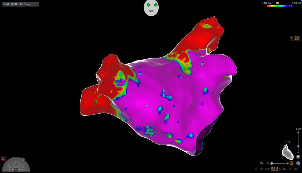 This is a really “Durable” PVI! 22 years later a PVI done with 4mm catheter and Lasso by @Scanav1Mauricio patient recurred with PAF 19 years after procedure, only LIPV was connected and there was antral RSPV signals. @LuigiDiBiaseMD @natale_md @Dr_Santangeli @CarinaHardy4