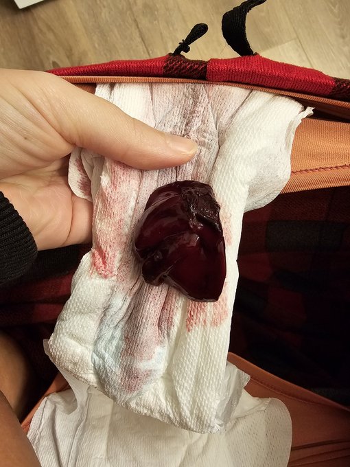 clots