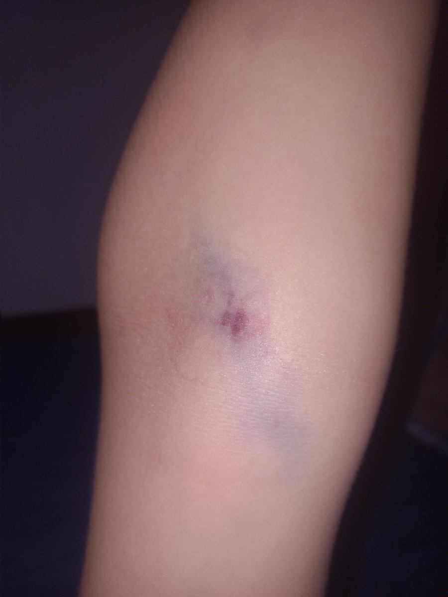 Hoy fuimos a la toma de muestras <a href="/ucchristus/">UC CHRISTUS</a> de #Melipilla con mi hijo, la enfermera olvidó un tubo y no quedó otra alternativa que pinchar DOS VECES, ¿ahora cómo le saco el trauma <a href="/ucchristus/">UC CHRISTUS</a>? Además mala mano, mi hijo gritaba del dolor 😡😡😡😡😡