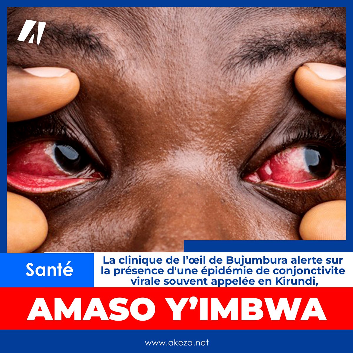 akezanet's tweet photo. 🔴🚨 𝐀𝐥𝐞𝐫𝐭𝐞 𝐒𝐚𝐧𝐭𝐞́ : La clinique de l’œil de Bujumbura ( @OeilClinique) confirme la présence d'une épidémie de conjonctivite virale dans notre communauté, souvent appelée en Kirundi, 𝐀𝐌𝐀𝐒𝐎 𝐘’𝐈𝐌𝐁𝐖𝐀.

Cela ressort d’un communiqué sorti ce mardi 30 Janvier 2024, par cette clinique via ses réseaux sociaux pour alerter sur la présence de cette épidémie :   « Nous vous informons de la présence d'une 𝙚́𝙥𝙞𝙙𝙚́𝙢𝙞𝙚 𝙙𝙚 𝙘𝙤𝙣𝙟𝙤𝙣𝙘𝙩𝙞𝙫𝙞𝙩𝙚 𝙫𝙞𝙧𝙖𝙡𝙚 𝙙𝙖𝙣𝙨 𝙣𝙤𝙩𝙧𝙚 𝙘𝙤𝙢𝙢𝙪𝙣𝙖𝙪𝙩𝙚́. La conjonctivite virale, souvent appelée "amaso y’imbwa", est une infection oculaire contagieuse qui peut causer rougeur, démangeaison, et un inconfort notable », précise la clinique.

⚠️ 𝐒𝐲𝐦𝐩𝐭𝐨̂𝐦𝐞𝐬 𝐚̀ 𝐬𝐮𝐫𝐯𝐞𝐢𝐥𝐥𝐞𝐫 :

· Rougeur ou inflammation de la conjonctive (la partie blanche de l'œil)

· Sécrétions oculaires, pouvant être claires ou légèrement jaunes

· Sensation de sable ou de corps étranger dans les yeux

· Gonflement des paupières

· Sensibilité accrue à la lumière

🔆 𝐌𝐞𝐬𝐮𝐫𝐞𝐬 𝐝𝐞 𝐩𝐫𝐞́𝐯𝐞𝐧𝐭𝐢𝐨𝐧 :

1. Hygiène des mains : Lavez-vous les mains régulièrement avec de l'eau et du savon pendant au moins 20 secondes, surtout après tout contact avec une personne infectée ou leurs effets personnels.

2. Évitez de toucher vos yeux : Évitez de vous frotter les yeux avec les mains non lavées pour empêcher la propagation du virus.

3. Utilisez des mouchoirs jetables : Utilisez-les pour essuyer vos yeux et jetez-les immédiatement après usage.

4. Ne partagez pas d'objets personnels : Évitez de partager des serviettes, des lunettes ou du maquillage.

5. Consultez un professionnel de la santé : Si vous présentez des symptômes de baisse de vision, consultez immédiatement un spécialiste. La conjonctivite virale est souvent bénigne et se résout d'elle-même, mais une attention professionnelle peut soulager les symptômes et prévenir la propagation.

#lesbeautesdecheznous #akezanet #Sante  #Burundi @mspls_bdi @MininterInfosBi @NtareHouse @GeneralNeva @BurundiGov @WhoBurundi @WHO