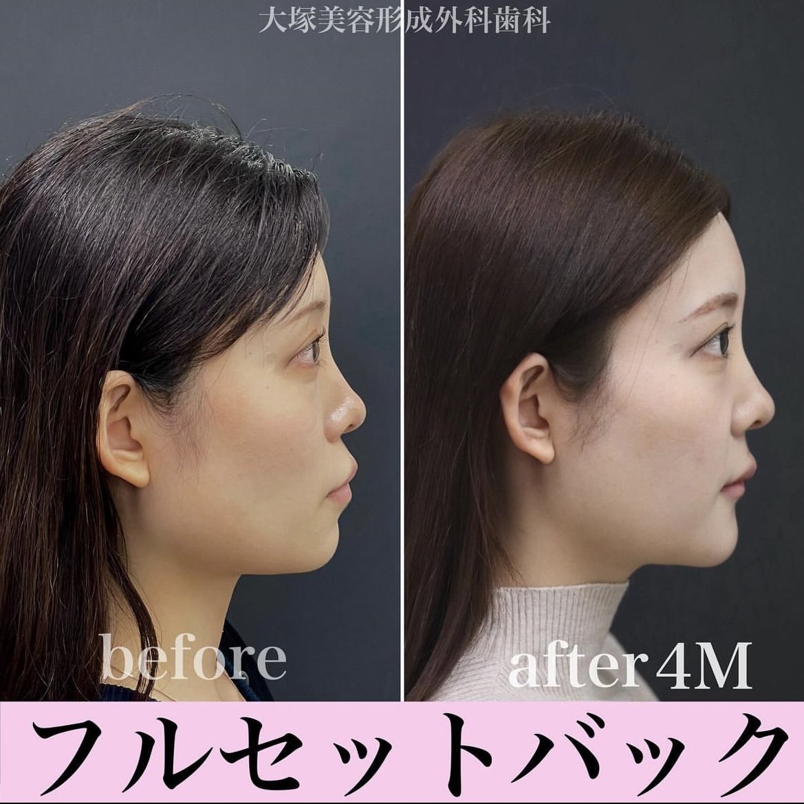 otsukadental's tweet photo. セットバックの症例です🩵

4番目の歯を上下4本抜歯して口元を下げる手術です🦷

リスク:腫れ/内出血/感覚麻痺/赤み/感染/左右差
料金110万円※別途麻酔代入院費

#美容整形 #大塚美容矯正歯科 #セットバック #フルセットバック #オトガイ https://t.co/ctcoleFjmn