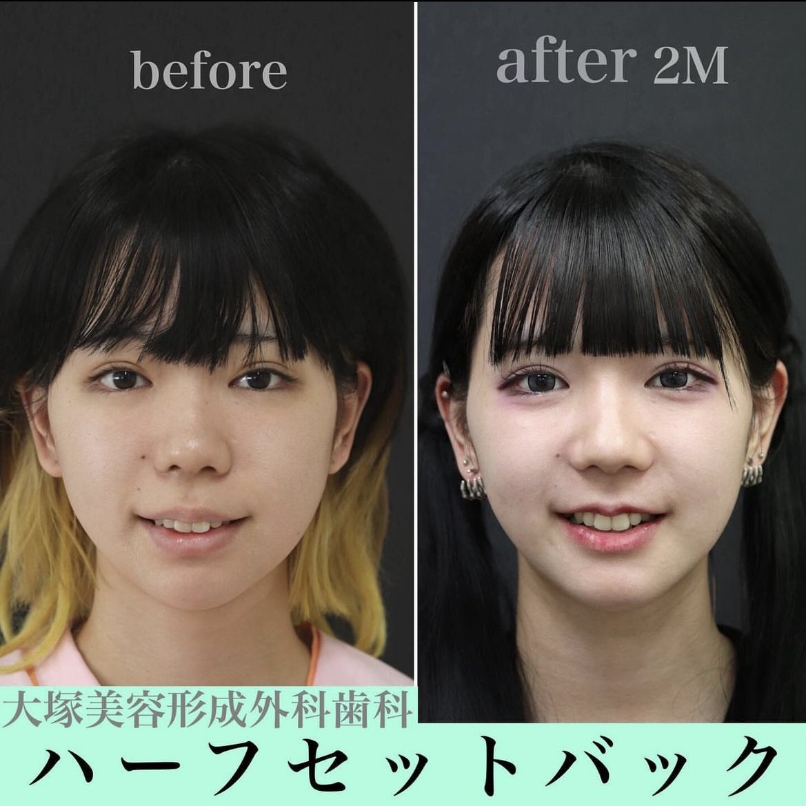 otsukadental's tweet photo. セットバックの症例です🩵

4番目の歯を上下4本抜歯して口元を下げる手術です🦷

リスク:腫れ/内出血/感覚麻痺/赤み/感染/左右差
料金110万円※別途麻酔代入院費

#美容整形 #大塚美容矯正歯科 #セットバック #フルセットバック #オトガイ https://t.co/ctcoleFjmn