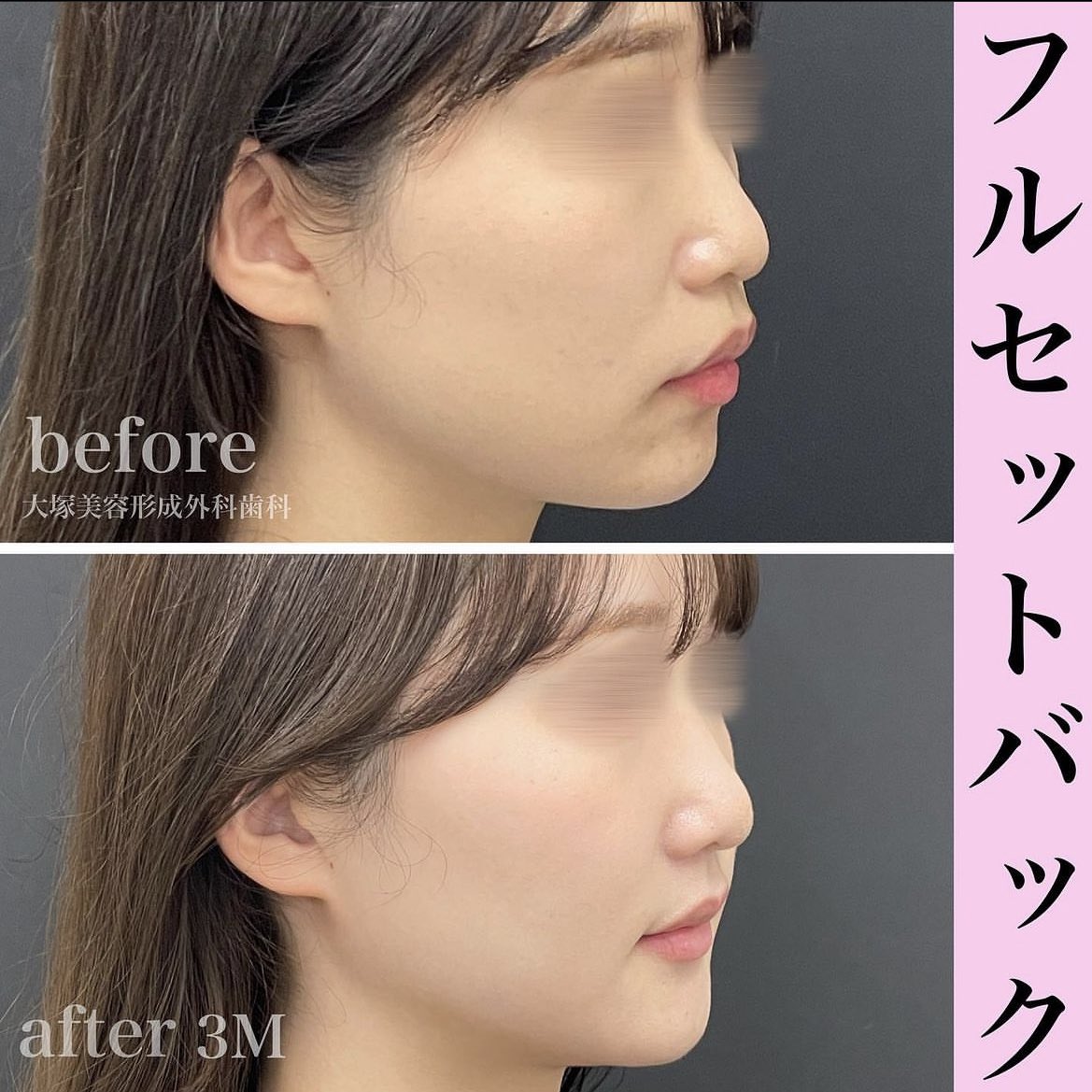 otsukadental's tweet photo. セットバックの症例です🩵

4番目の歯を上下4本抜歯して口元を下げる手術です🦷

リスク:腫れ/内出血/感覚麻痺/赤み/感染/左右差
料金110万円※別途麻酔代入院費

#美容整形 #大塚美容矯正歯科 #セットバック #フルセットバック #オトガイ https://t.co/ctcoleFjmn