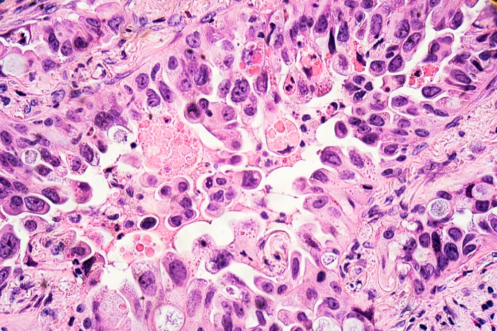IHIEurope's tweet photo. The IMI CANCER-ID project applied molecular techniques 🧬 to investigate whether mutant cells are causing patients to reject a commonly-used combination therapy for lung cancer.👉 Read the story here: https://t.co/rojzi9GBVt
#EUHealth #EUBeatsCancer #LungCancer #HealthResearch https://t.co/uiTVa7CjWd