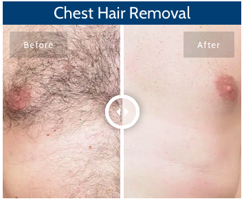 Unleash your confidence with our game-changing chest hair removal! 🚀✨ Say goodbye to unwanted hair and hello to a smoother, more confident you. Check out the incredible before-and-after results! 💪 #HairRemoval #ConfidenceBoost Book today! bit.ly/WAThairremoval…
