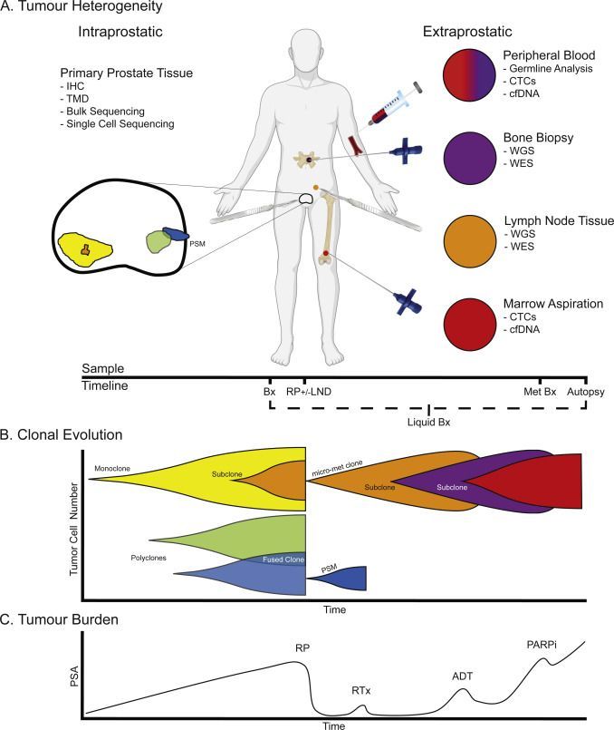 Throwback Thursday: A Systematic Review of Prostate Cancer Heterogeneity: Understanding the Clonal Ancestry of Multifocal Disease by Andrew Erickson et al buff.ly/3gawZ1z #ProstateCancer #UroSoMe #Medtwitter