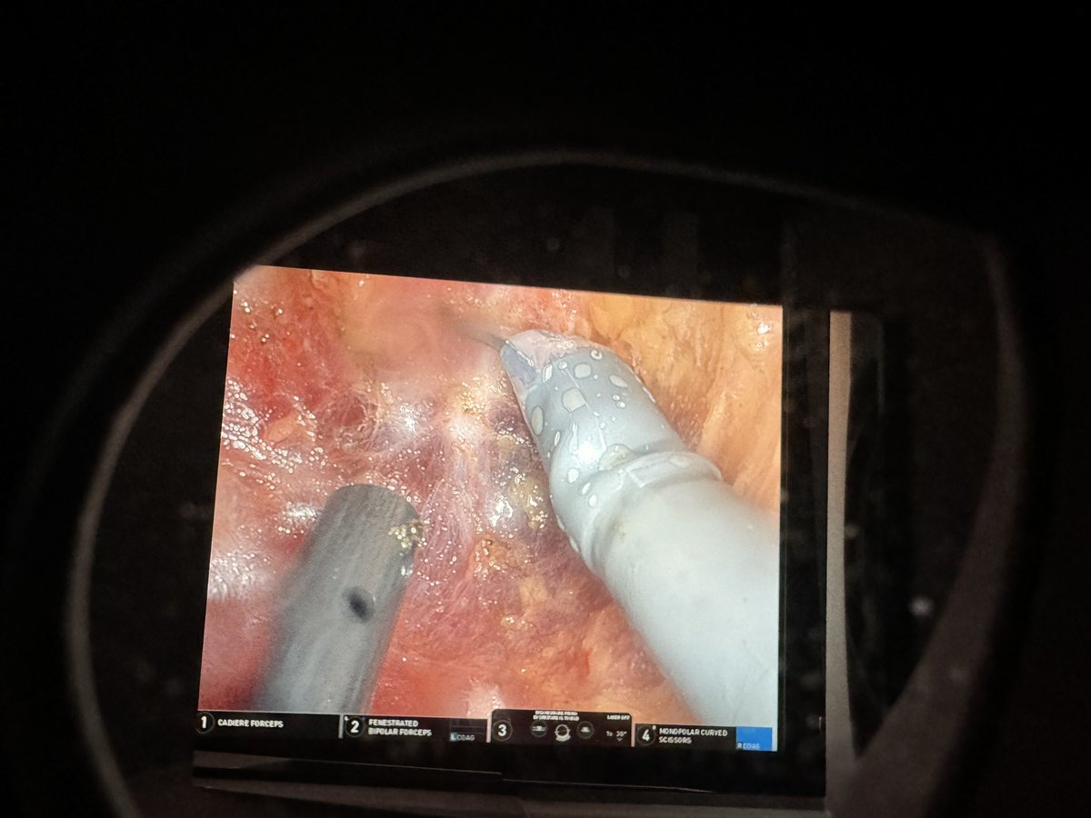 In a single observed case of 🤖 TME, in the pelvis, an additional 11 camera cleanings were required adding an additional 18 minutes to surgery. Perhaps the most overlooked opportunity in MIS. Endoscopy figured it out🤷🏼‍♂️ @IntuitiveSurg @StrykerEndo @Olympus_Corp
