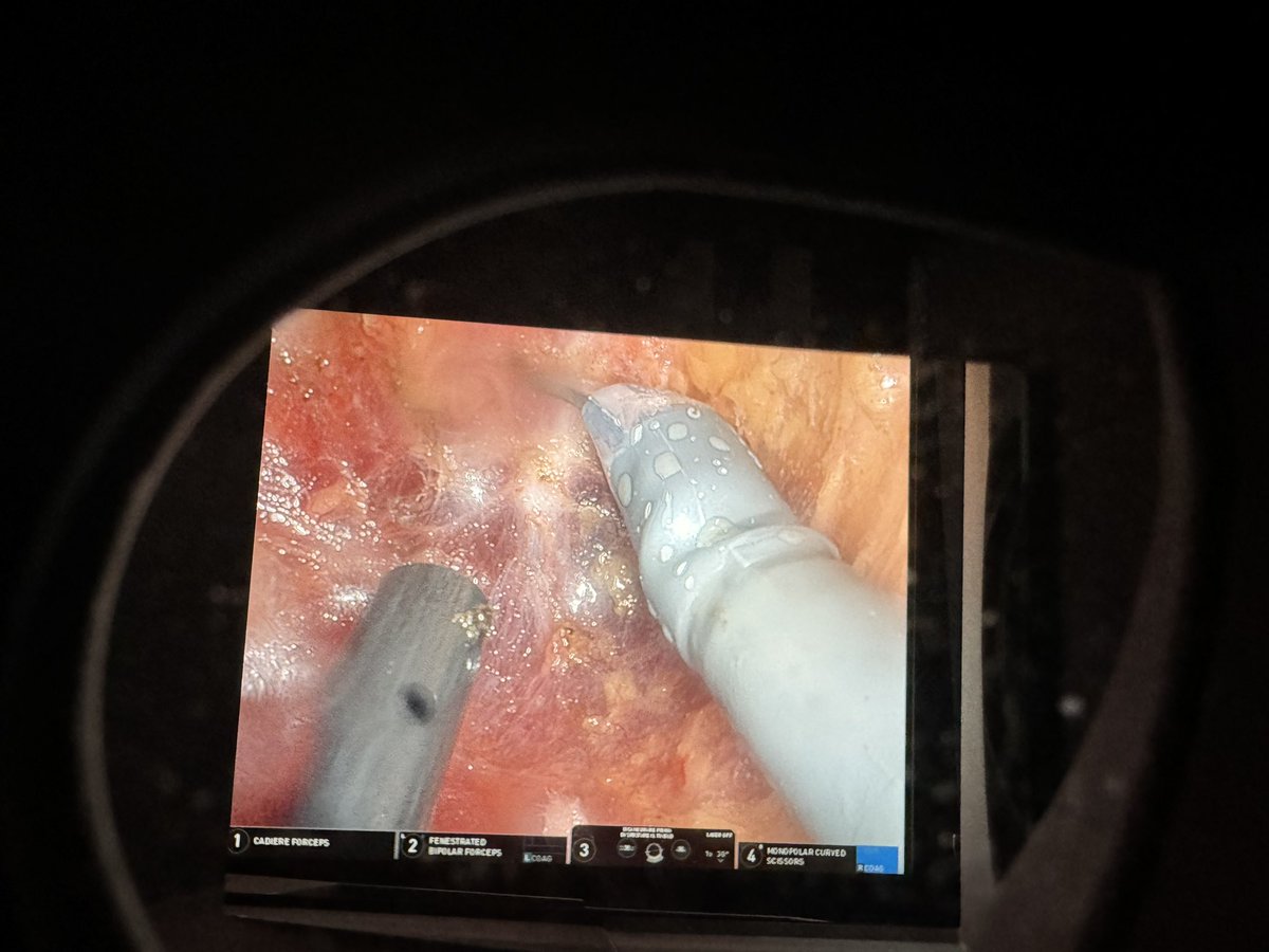 In a single observed case of 🤖 TME, in the pelvis, an additional 11 camera cleanings were required adding an additional 18 minutes to surgery. Perhaps the most overlooked opportunity in MIS. Endoscopy figured it out🤷🏼‍♂️ <a href="/IntuitiveSurg/">Intuitive</a> <a href="/StrykerEndo/">Stryker Endoscopy</a> <a href="/Olympus_Corp/">Olympus</a>