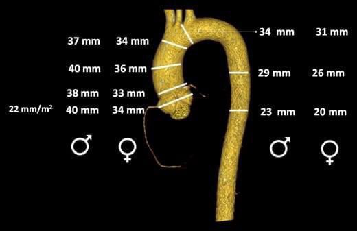 Maximum diameter reference values for different segments of the aorta according to gender
academic.oup.com/ehjcimaging/ar…

#CardiovascularImaging #KnowYourGuidelines