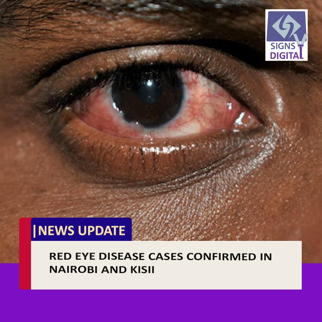 SignsTvKenya's tweet photo. The Ministry of Health has confirmed the occurrence of three cases of Red Eye Disease in Nairobi.
Patrick Amoth, the Public Health Director General, mentioned that one case has also been documented in Kisii.
#ibes #Amoth #Cactus # https://t.co/H9hB79pBFU