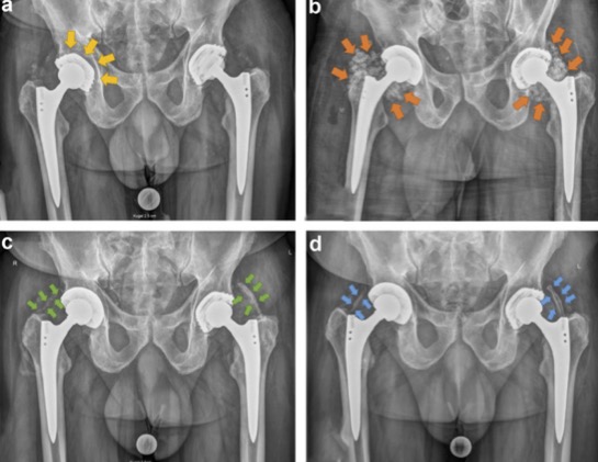 What to do when faced with bilateral hematogenous PJI, bug that is difficult to treat, and no possibility of source control? This case report discusses some creative solutions. #orthotwittter @DrAntoniaChen @EmanueleChisari @laura_certain arthroplastytoday.org/article/S2352-…