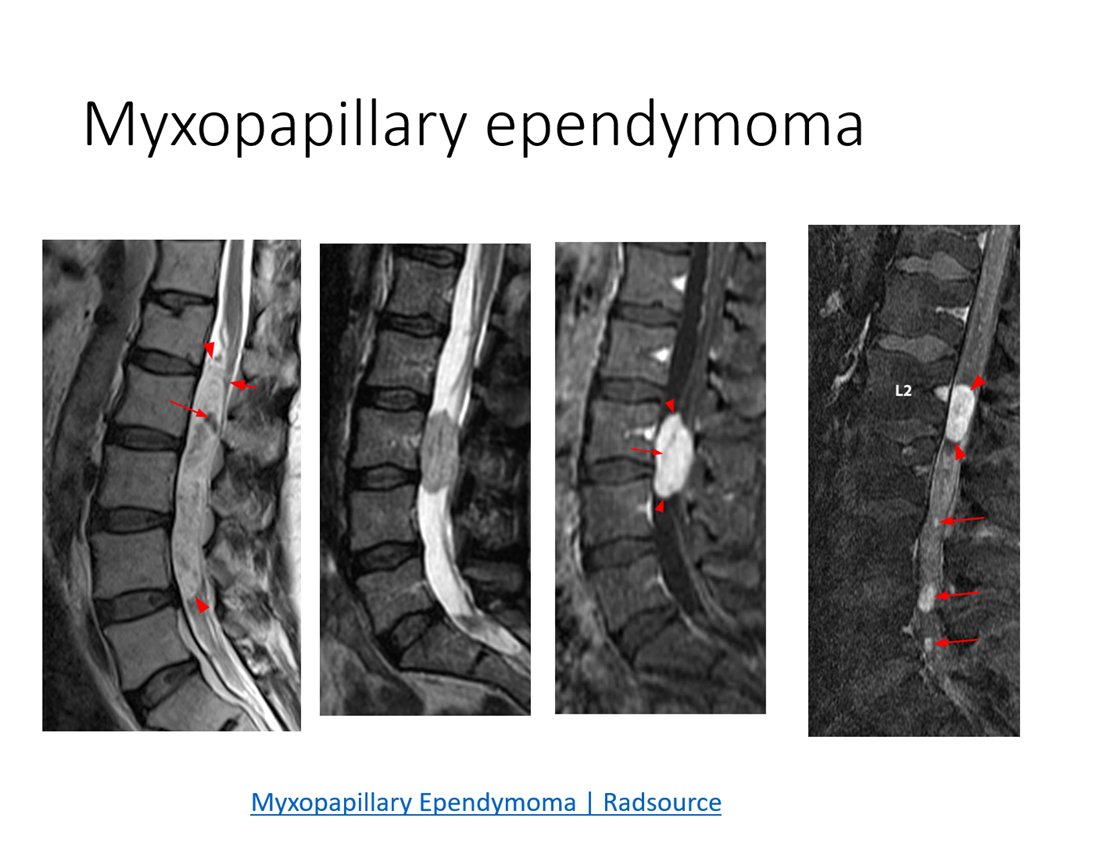 馬尾らへんの粘液性腫瘍をみたら鑑別に！粘液乳頭状上衣腫 myxopapillary ependymoma
•若年男性に好発
•脊髄円索～終糸、馬尾に発生、硬膜内髄買い腫瘍
•WHO2021でGrade2に変更
•多発傾向、再発・髄膜播種、遠隔転移をきたす
•T2WI高信号、強い造影効果。腫瘍内部および上下端に出血
#Rdiag