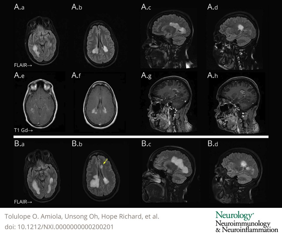 Diagnostic &amp; Treatment Challenges: A 42-Year-Old Woman With Rapidly Expanding White Matter Lesions—From the National Multiple Sclerosis Society Case Conference Proceedings bit.ly/3OpIyUN

#MS #NeuroTwitter