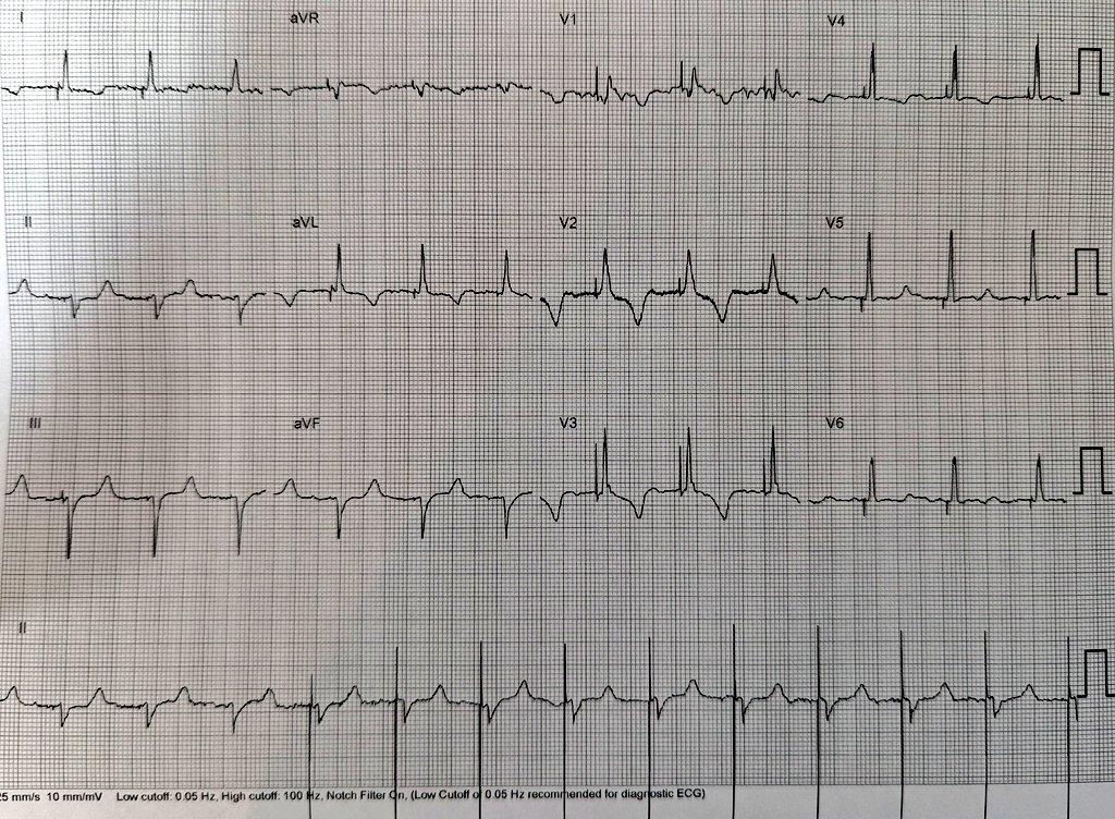 #EPeeps: simultaneous AV ablation + #LBBP in a patient with permanent AF + LVEF 35%. CSP achieves excellent results in these patients. @LAHRSonline1 @colegioelectro1