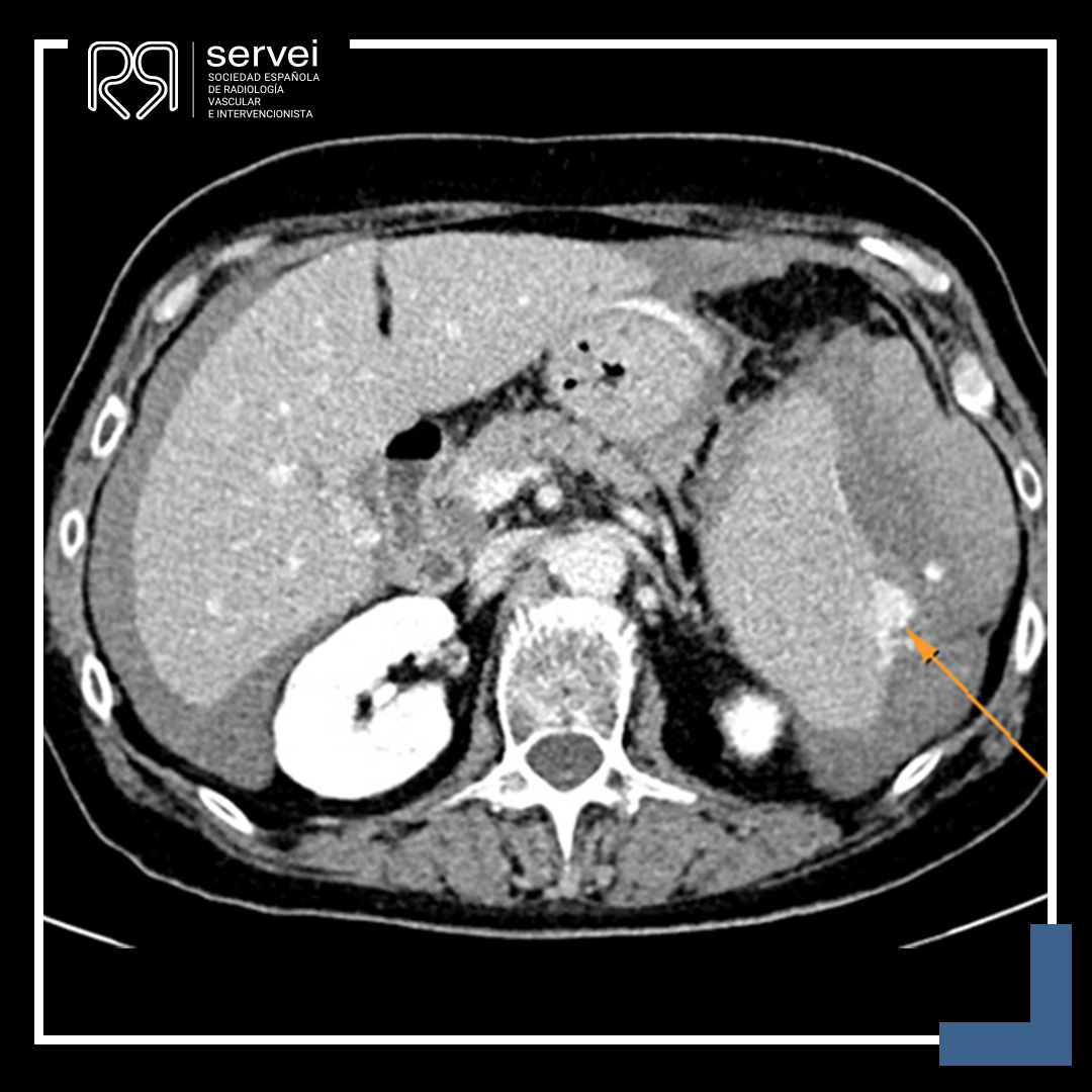 SERVEISoc's tweet photo. 💥 ¡CASO CLÍNICO DE FEBRERO!

¡No os perdáis en la web este interesante caso que resuelven de #urgencia nuestros compañeros de la Ud. de #RadiologiaIntervencionista del HCU Lozano Blesa de Zaragoza!

👇👇👇
https://t.co/WfWNVl8Q8P

#IRad #InterventionalRadiology https://t.co/KVCS73tIzS