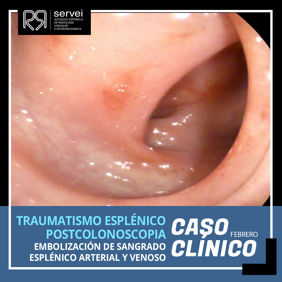 SERVEISoc's tweet photo. 💥 ¡CASO CLÍNICO DE FEBRERO!

¡No os perdáis en la web este interesante caso que resuelven de #urgencia nuestros compañeros de la Ud. de #RadiologiaIntervencionista del HCU Lozano Blesa de Zaragoza!

👇👇👇
https://t.co/WfWNVl8Q8P

#IRad #InterventionalRadiology https://t.co/KVCS73tIzS