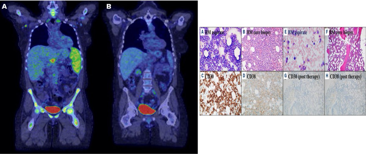 smbenlazar's tweet photo. Daratumumab and brentuximab vedotin combination therapy in T-cell  acute lymphoblastic leukemia refractory to conventional chemotherapy and  allogeneic stem cell transplant https://t.co/NEYDLr65p2 https://t.co/GIaVKbXoGW