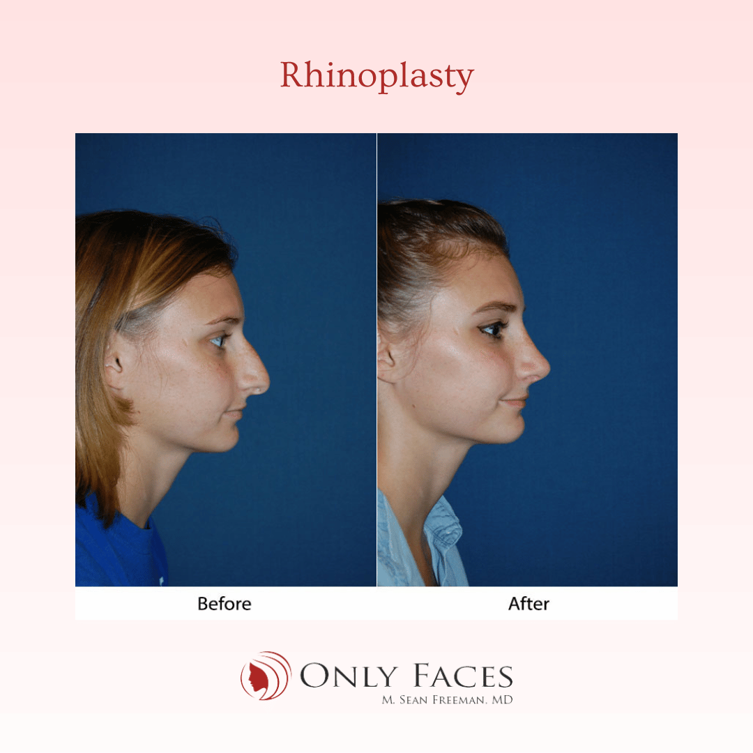 OnlyFacesCLT's tweet photo. This 20-year-old is 3 months post-op from a #Rhinoplasty. #OnlyFaces https://t.co/2X9or7SV9r
