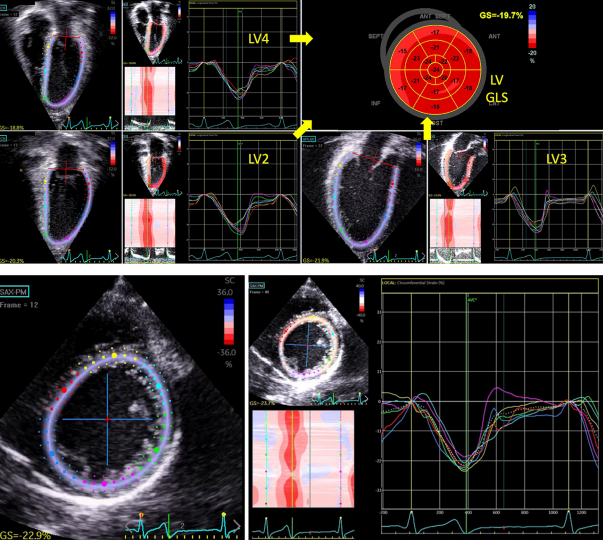 🫀NEW GUIDELINES 🫀 bit.ly/3ukhn6X
We have just released two NEW #guidelines to kick off #AmericanHeartMonth! 

#PedsCards #echofirst