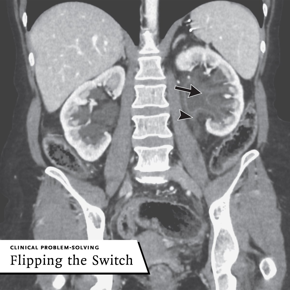 A 43-year-old woman presented with a 1-week history of dysuria and lower abdominal pressure but no fevers, hematuria, or flank pain. She had had several urinary tract infections in the past 2 years. Read more in the latest Clinical Problem-Solving: nej.md/4bl6lyQ