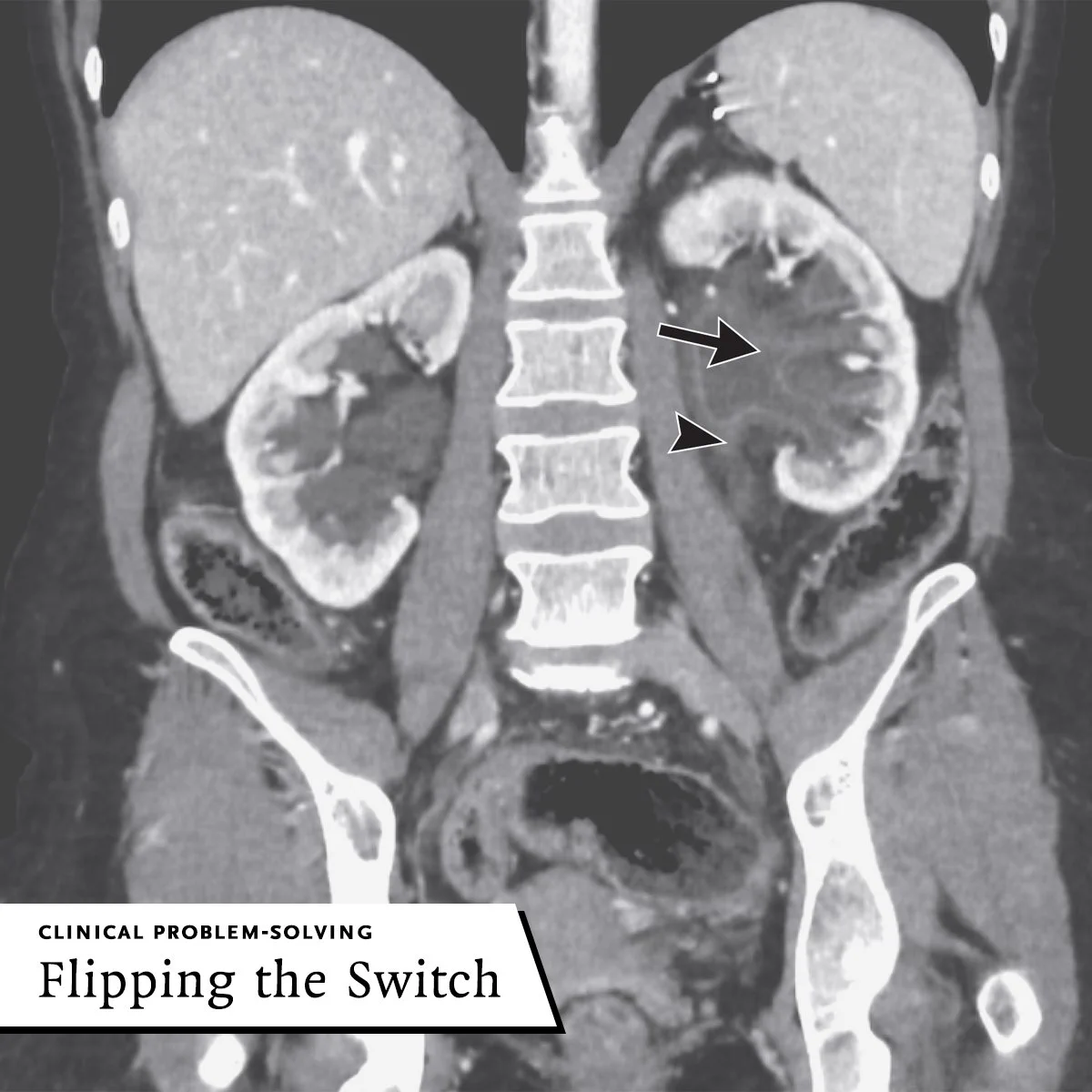 CLINICAL PROBLEM-SOLVING
Flipping the Switch

Urothelial Thickening and Enhancement of a Dilated Left Renal Collecting System and Upper Ureter