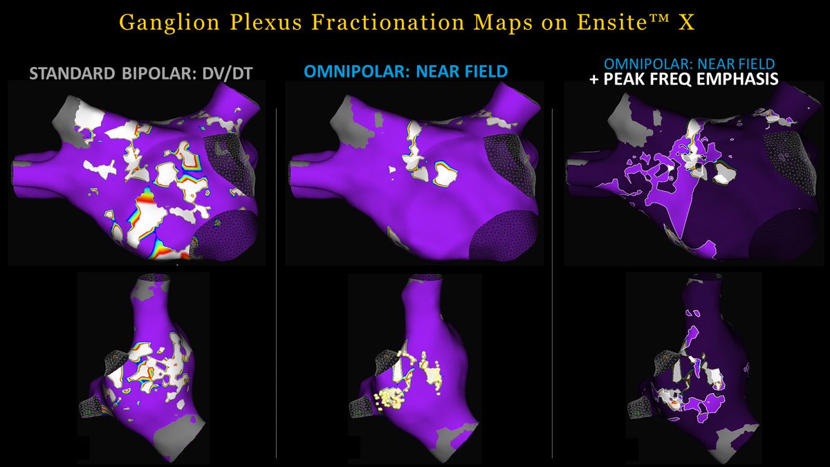 EPinDMV's tweet photo. Why settle for bipolar abs dv/dt when you can gain specificity w/ Omnipolar Tech, #OTNearField annotation &amp; Peak Freq #EmphasisMaps? Check out how these tools clearly ID those Ganglion Plexus sites! 📍
Procedure credit: Dr. @lorvidhaya 
Maps by @EP_HeatherMalek https://t.co/3nr5jbCCW2