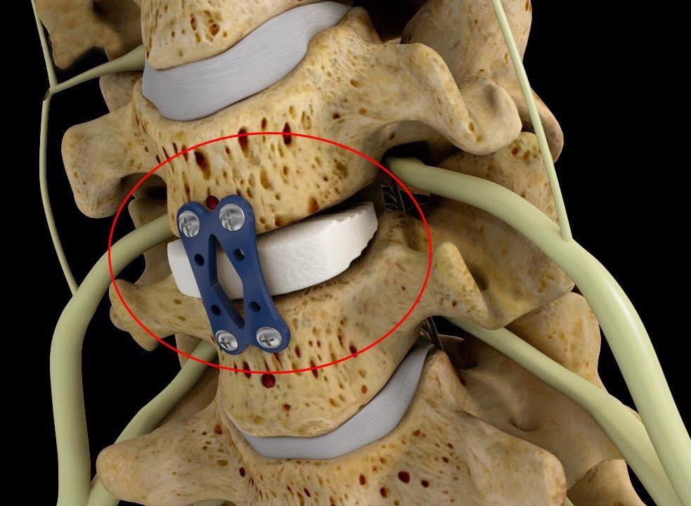 Hi friends! Has anyone had or know someone who has had Anterior cervical discectomy and fusion surgery?