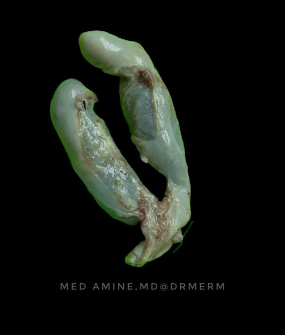 Drmerm's tweet photo. Double gallbladder is a rare congenital biliary anomaly
#PathTwitter #pathology #gross  #GIpath #medpath #MedTwitter  #Xpath https://t.co/cOdCb41l4m