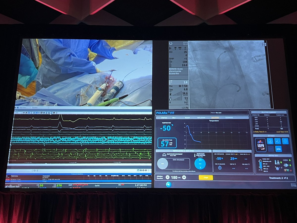 Case transmissions #AFsymposium2024 Watchman left atrial appendage closure with single-step Transseptal access - Moussa Mansour, MD PVI using POLARx FIT novel expandable cryoballoon with single-step transseptal access - Bradley Knight, MD