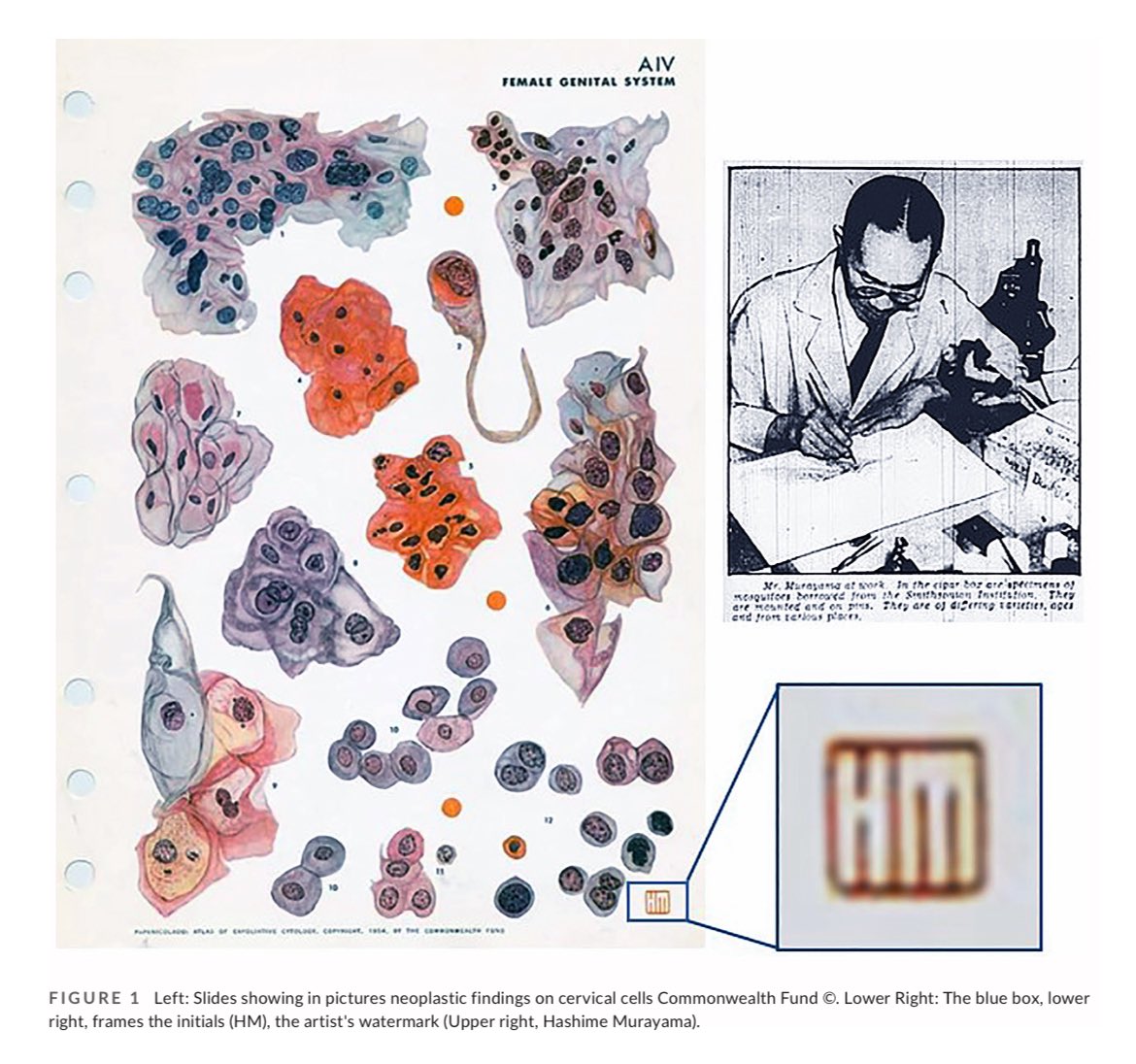 tlabiano's tweet image. 🙌🏼🔥JUST PUBLISHED on @CytopathologyJ
#Pathart and #Cytopath!! Beauty must be shared.
🤓🫶🏼Thank you @JMGardnerMD @Sara_Jiang @sza_jhcyto @mdlozanoe @edusqo @gildasantoscyto @LizaMQuintana and all #PathXfamily for sharing and inspiring 🌍🌎🔬🔝
Link: doi.org/10.1111/cyt.13…