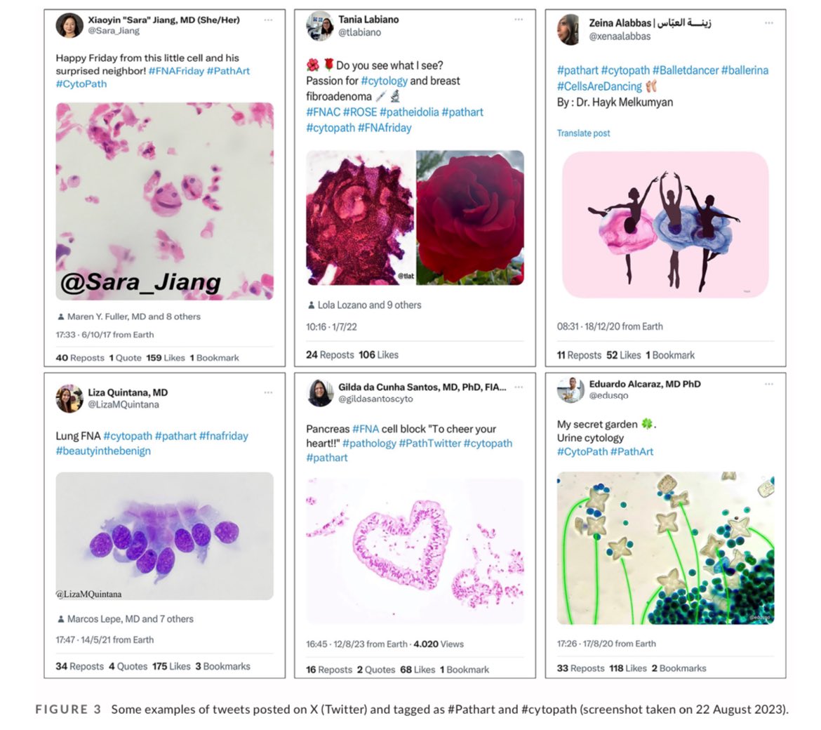 tlabiano's tweet image. 🙌🏼🔥JUST PUBLISHED on @CytopathologyJ
#Pathart and #Cytopath!! Beauty must be shared.
🤓🫶🏼Thank you @JMGardnerMD @Sara_Jiang @sza_jhcyto @mdlozanoe @edusqo @gildasantoscyto @LizaMQuintana and all #PathXfamily for sharing and inspiring 🌍🌎🔬🔝
Link: doi.org/10.1111/cyt.13…