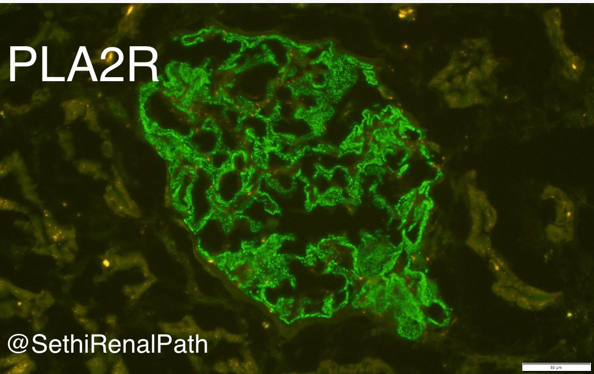 SethiRenalPath's tweet photo. Nuances of Membranous antigen staining:

1. PLA2R: granular staining along GBM
2. THSD7A: lumpy-discrete, scattered deposits along GBM (linear staining=negative)
3. EXT: granular staining along GBM, can be intense
4. NELL1: granular, can be segmental,sometimes appears linear. 1/2 https://t.co/tQYFMzZghN