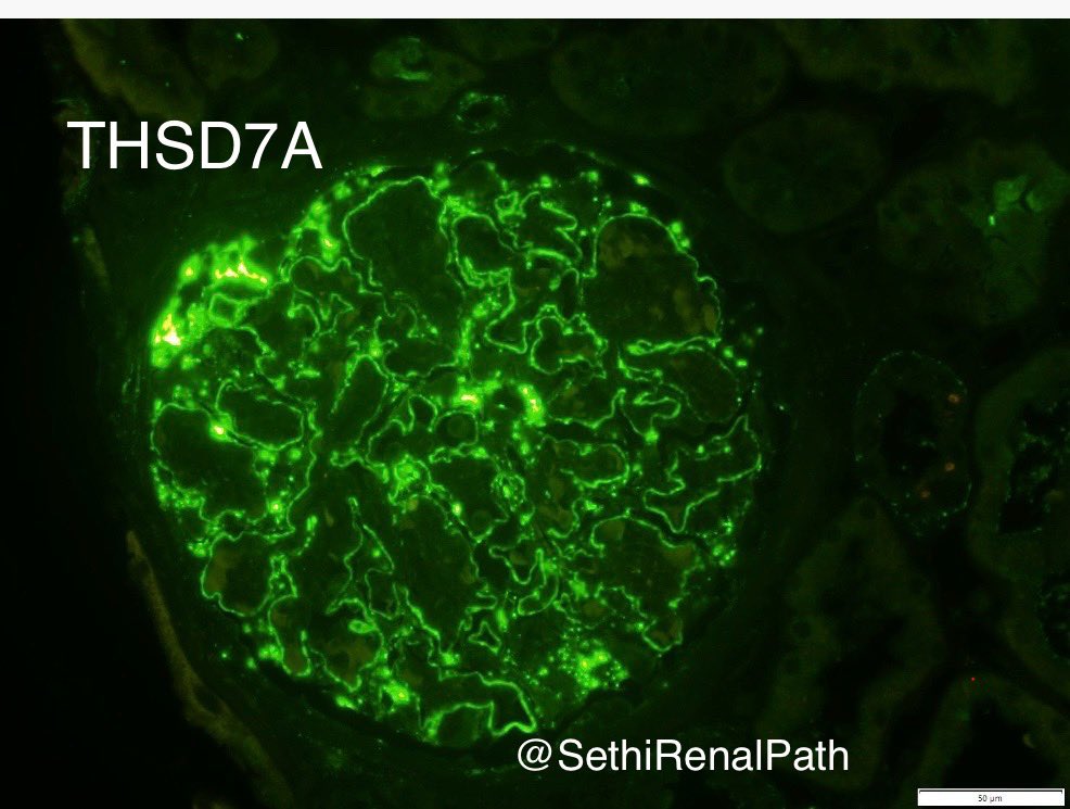 SethiRenalPath's tweet photo. Nuances of Membranous antigen staining:

1. PLA2R: granular staining along GBM
2. THSD7A: lumpy-discrete, scattered deposits along GBM (linear staining=negative)
3. EXT: granular staining along GBM, can be intense
4. NELL1: granular, can be segmental,sometimes appears linear. 1/2 https://t.co/tQYFMzZghN