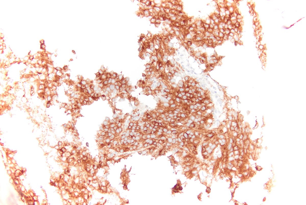 #pathologists what is your favored diagnosis of this bone lesion in a pediatric patient? H&E and ALK1 immunohistochemistry shown. #hemepath #pathology #pathtwitter