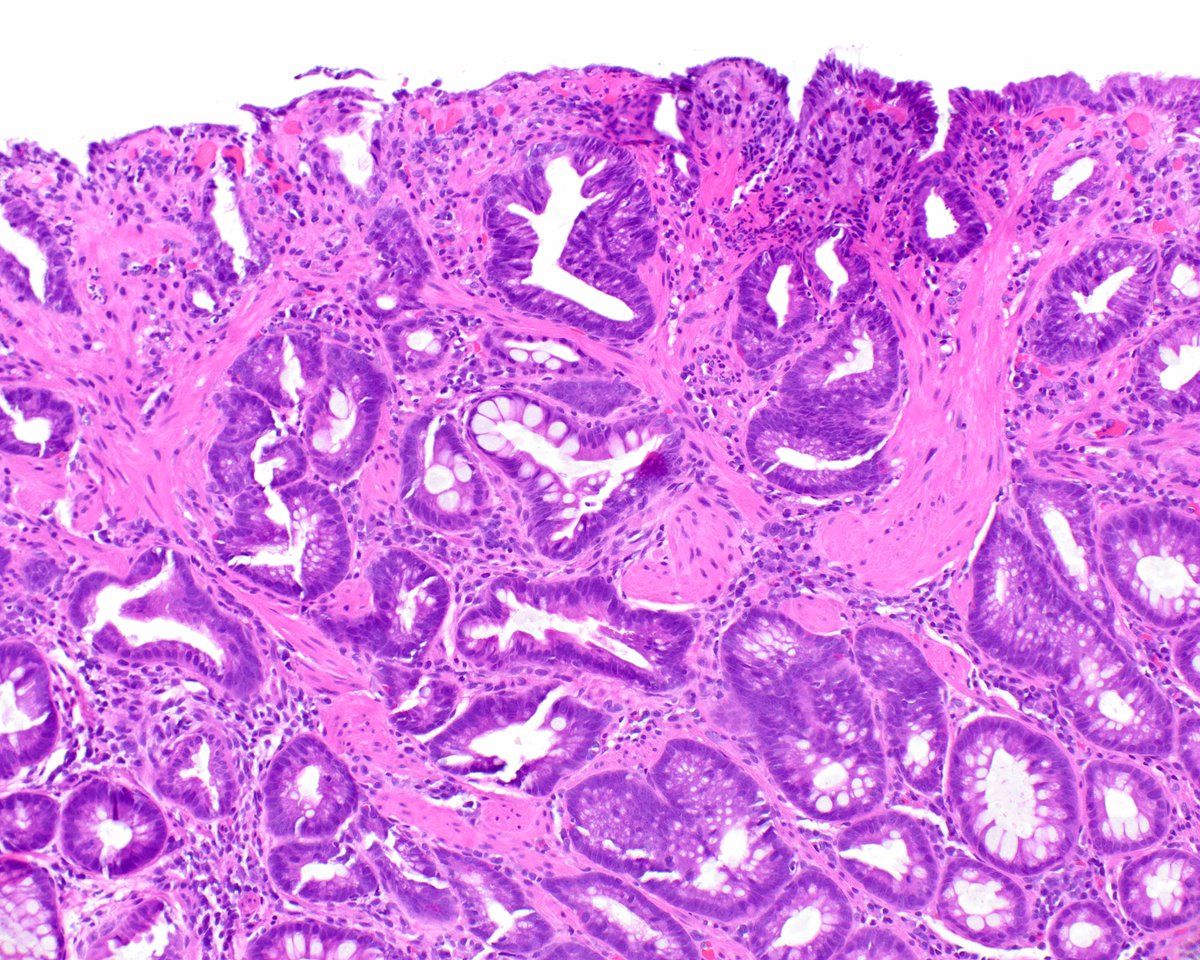 What a wonderful example of mucosal prolapse change in the rectum.  The lamina propria is replete with strands of smooth muscle and the surface is eroded. #UMiamiPath