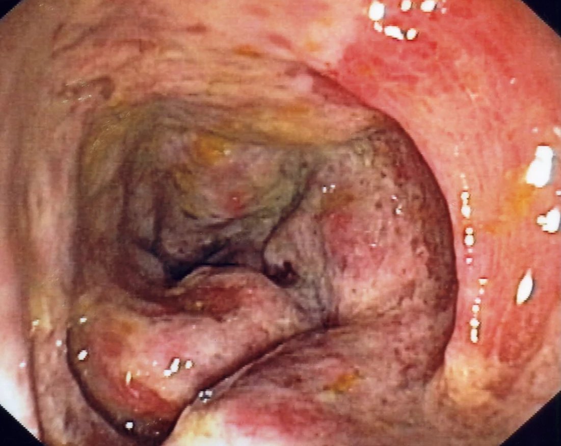 EndoCollab™ | GI Endoscopy Community tweet media