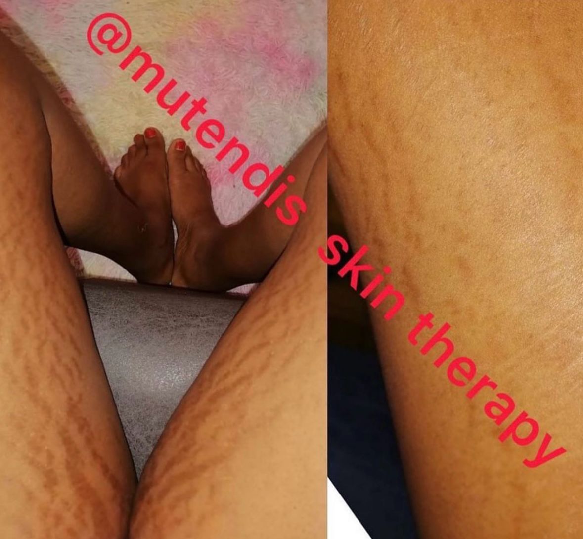 mutendiskinther's tweet photo. Call or WhatsApp 0764979469 to order stretch mark cream #BBMzansi https://t.co/DgDR6UguTr
