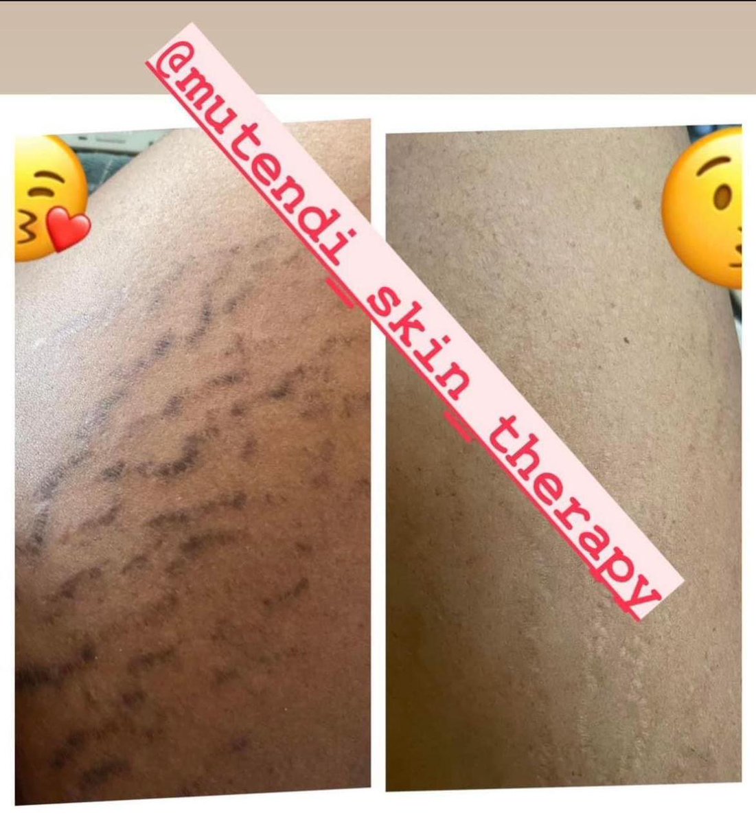 mutendiskinther's tweet photo. Call or WhatsApp 0764979469 to order stretch mark cream #BBMzansi https://t.co/DgDR6UguTr