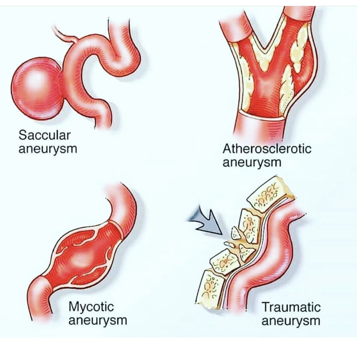 Which is most likely to rupture?