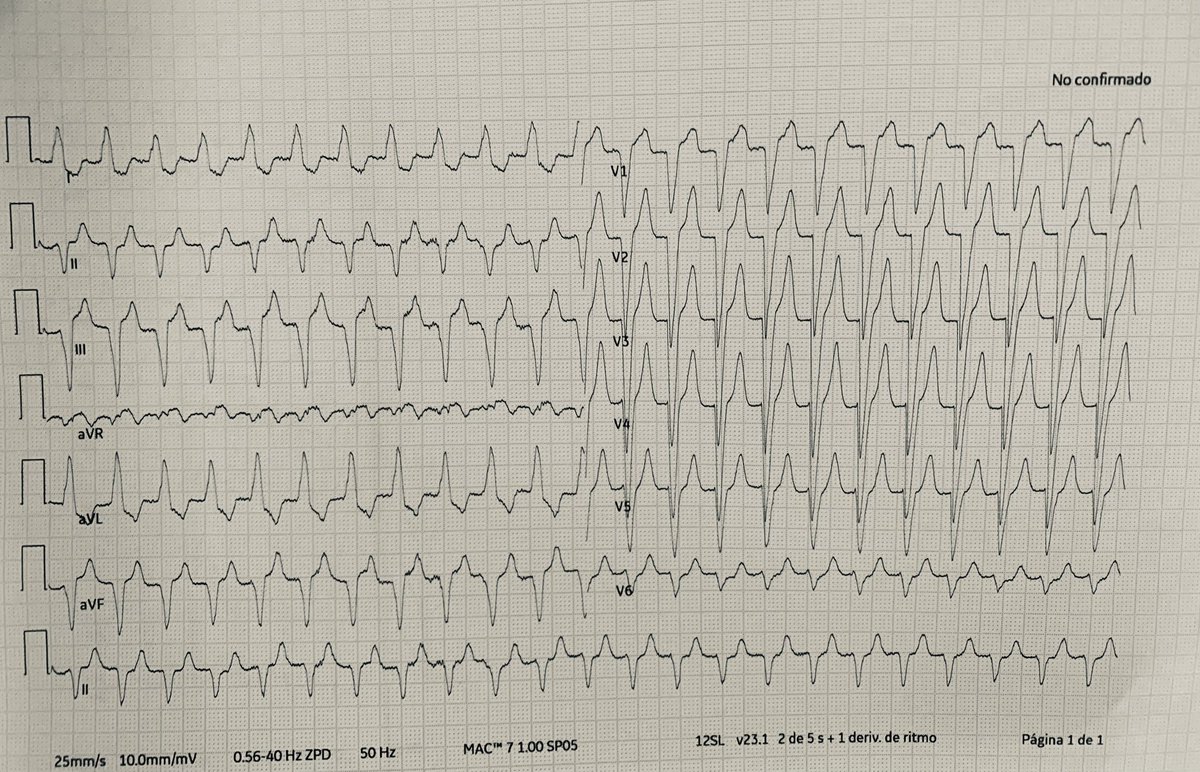 80 y/o 👵🏻 Electrocardiographic changes after TAVR: developed new LBBB and PRi prolongation. Incessant tachycardia on monitoring. #EKG was done. Asymptomatic. Thoughts? Next steps? #CardioTwitter #EPeeps #Cardiology