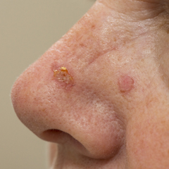 Macchie ruvide e squamose sulla pelle, di colore dal rosa al marrone, a volte pruriginose, potrebbero essere il segno di una #cheratosi attinica, una lesione delle #pelle da non sottovalutare perchè potrebbe trasformarsi in un tumore 👉tinyurl.com/5ak27ns5