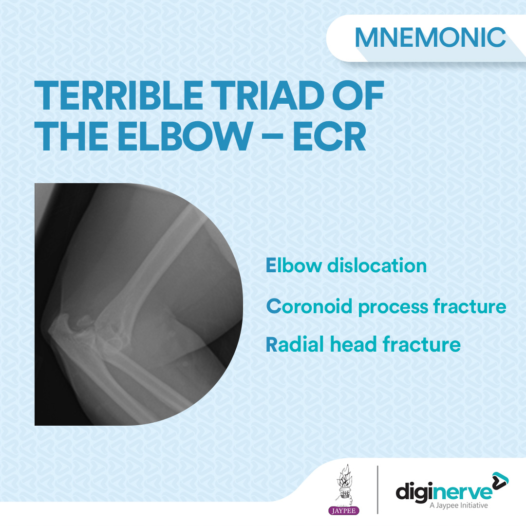 Terrible triad of elbow – ECR

#DigiNerve #MedicalStudents #MedicalStudies #MBBS #Mnemonic #TerribleTriad #ElbowInjury #ElbowTrauma #RadialHeadFracture #CoronoidProcessFracture #OlecranonFracture #ElbowDislocation #OrthopedicInjury #SportsInjury #OrthoRehab