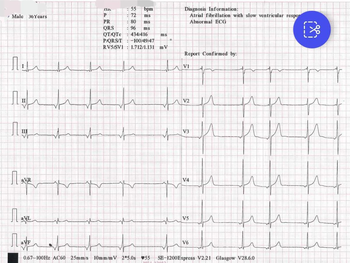Hi #epeeps. Wondering if you can shed some light on this #ECG #rhythym? Just junctional? Pre-excitation? Both? What kind of pathway if pre-excited? Thanks!